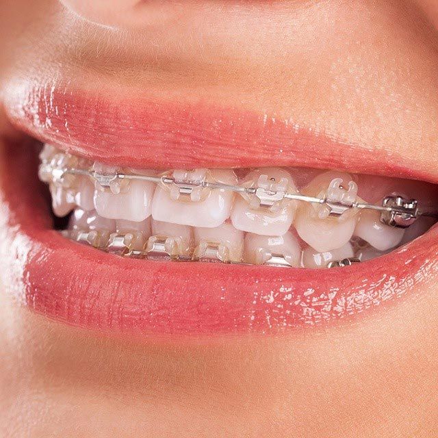 Tratamiento de ortodoncia