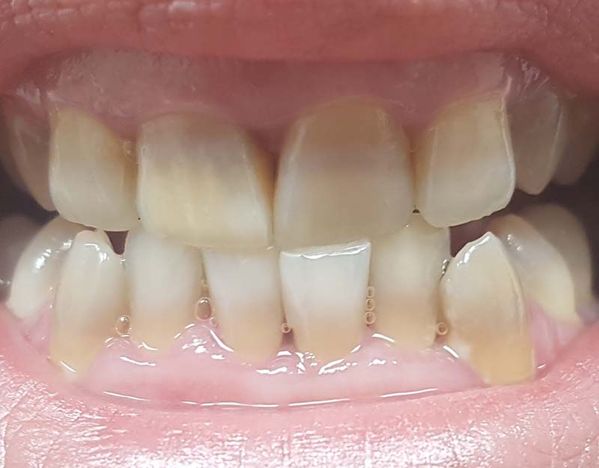 Estética de dientes