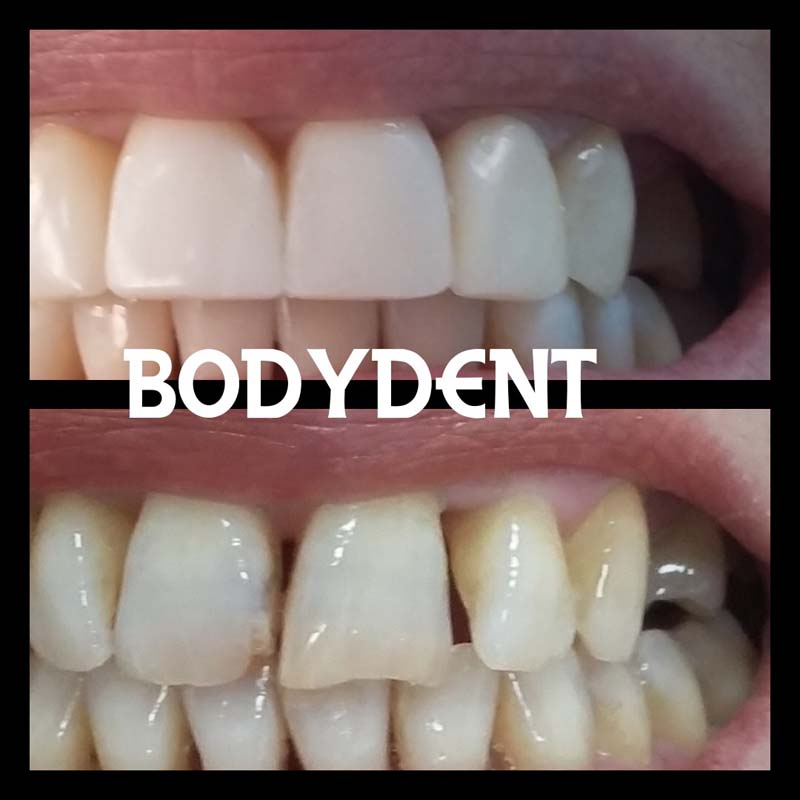 Clínica Dental Bodydent blanqueamiento dental