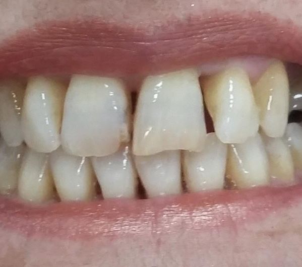 Clínica Dental Bodydent dientes feos