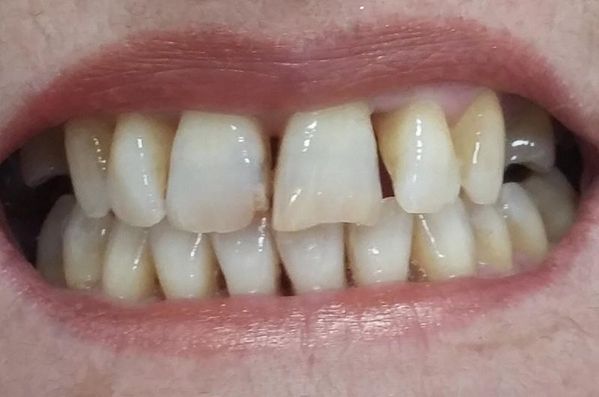 Clínica Dental Bodydent dientes feos