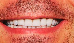 Clínica Dental Bodydent persona sin dientes